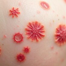 Choroby zakaźne skóry: Objawy, rodzaje i metody leczenia