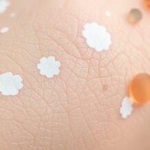 Liszaj twardzinowy: objawy, leczenie i wpływ na życie seksualne