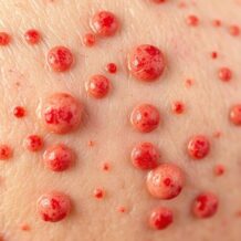 Trądzik grzybiczy: jak go rozpoznać i skutecznie leczyć?