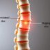 Przepuklina dysku: przyczyny, objawy i skuteczne leczenie