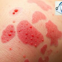 Róża – objawy, przyczyny i skuteczne metody leczenia choroby skóry