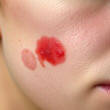 Zmiany skórne w chorobach reumatycznych: objawy i diagnostyka