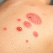 Choroby skóry moszny: rodzaje, objawy i podstawowa diagnostyka